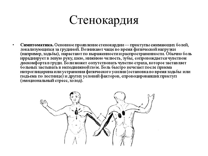 Стенокардия  Симптоматика. Основное проявление стенокардии — приступы сжимающих болей, локализующихся за грудиной. Возникают